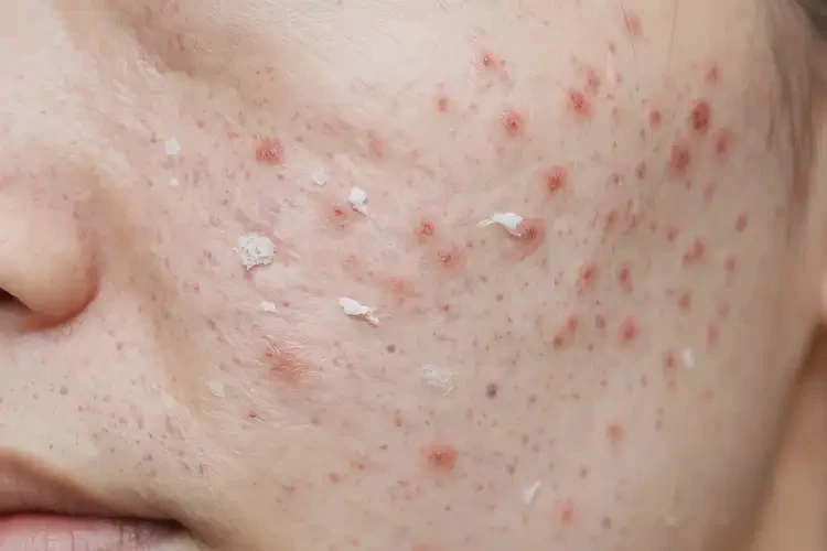 青年人屁股上容易起濕疹不管它會(huì)自己好嗎(圖3)