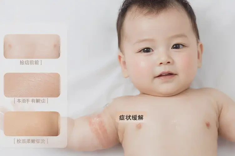 少兒手臂上出現(xiàn)濕疹可不可以徹底自愈(圖2)