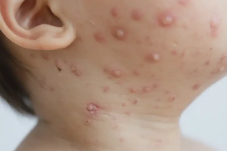 孩子脖子上起濕疹可以徹底自愈嗎(圖3)