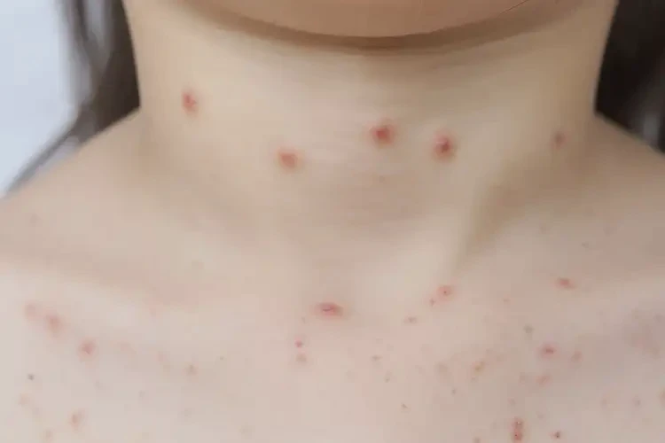 兒童脖子出現(xiàn)濕疹不管它會(huì)自己好嗎(圖4)