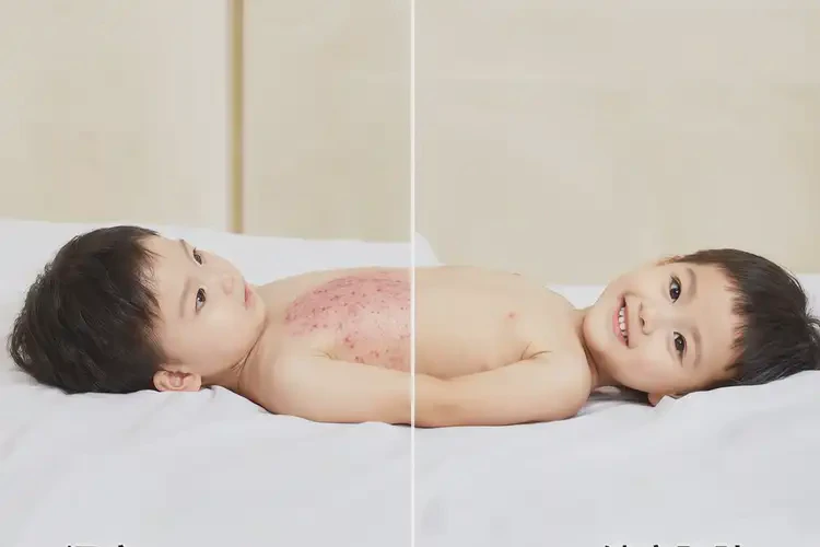 孩子肚子上長濕疹能夠徹底治愈嗎(圖4)