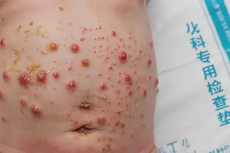 新生兒肚子上有濕疹不管它會自己自愈嗎(圖2)