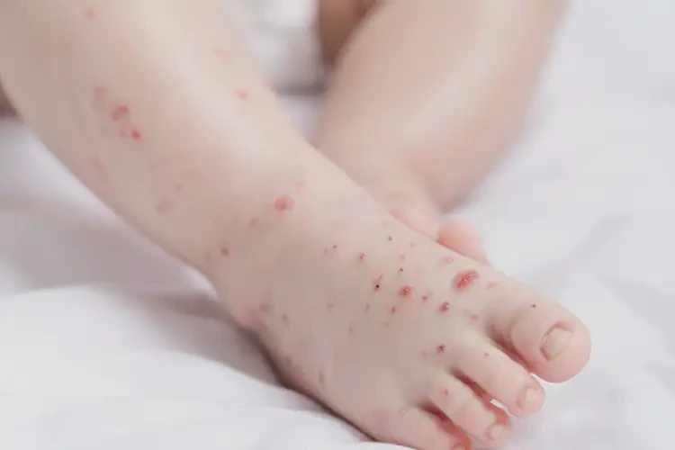 寶寶腳上偶爾長(zhǎng)濕疹可不可以徹底自愈(圖4)