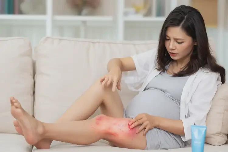 孕婦大腿上偶爾起濕疹能靠自己自愈嗎(圖4)