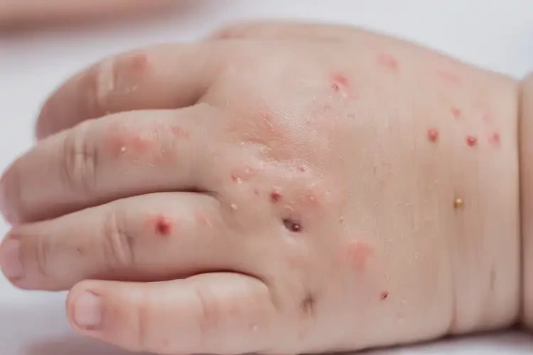 少兒手上有濕疹能徹底自愈嗎(圖4)