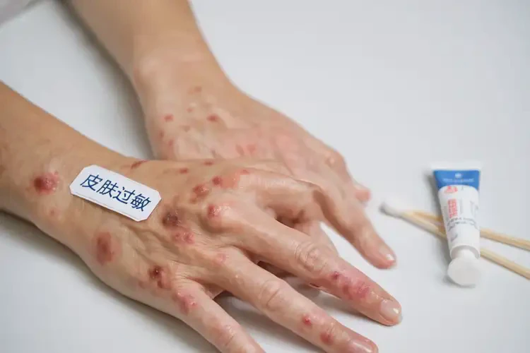 女人手上容易長濕疹能徹底自愈嗎(圖4)