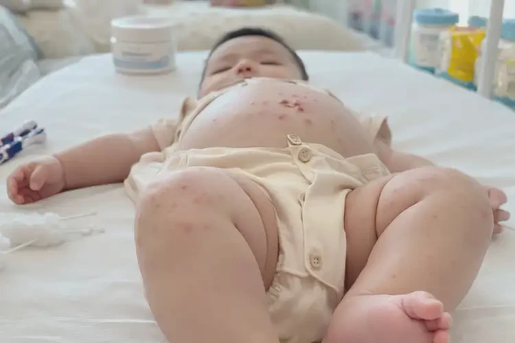 寶寶肚子偶爾長(zhǎng)濕疹能靠自己自愈嗎(圖4)