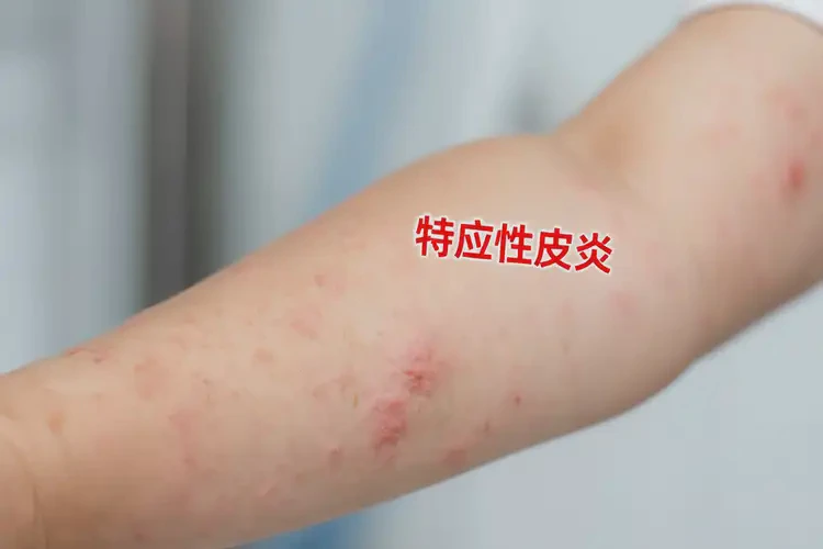 少兒全身容易長濕疹不管它會自己痊愈嗎(圖4)