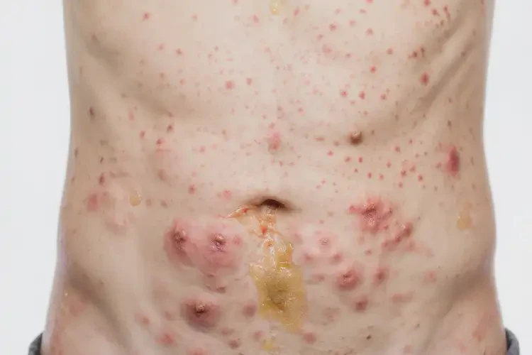 男生肚子起濕疹能靠自己自愈嗎(圖2)