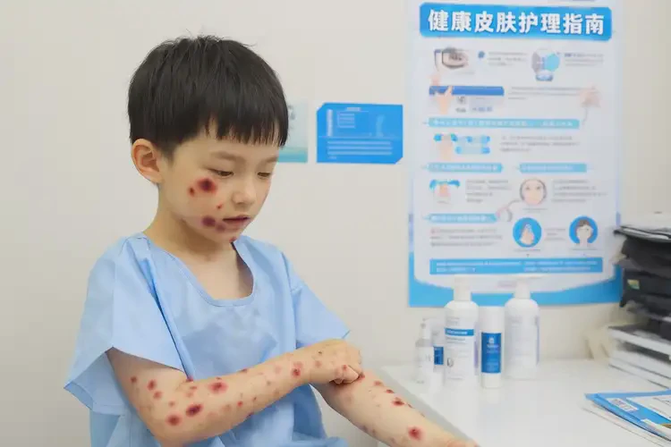 孩子全身容易起濕疹可不可以徹底自愈(圖4)