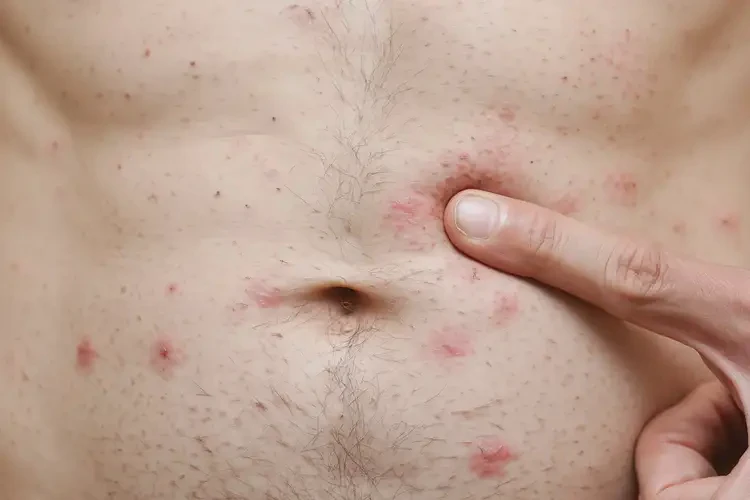 男性肚子上出現濕疹不管它會自己好嗎(圖4)