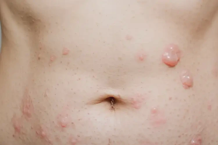 女性肚子偶爾長(zhǎng)濕疹不管它會(huì)自己好嗎(圖4)