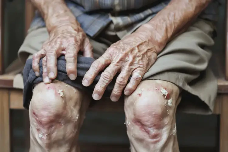 高齡老人小腿出濕疹能徹底自愈嗎(圖4)