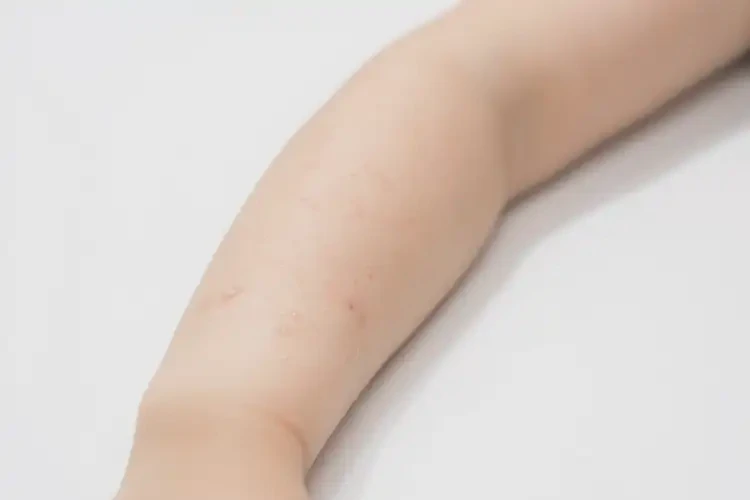 小孩手臂偶爾起濕疹能靠自己自愈嗎(圖1)