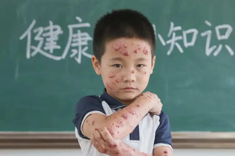 小學(xué)生全身經(jīng)常長(zhǎng)濕疹能靠自己自愈嗎(圖4)