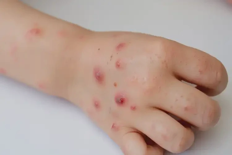 小兒手上經(jīng)常長濕疹不管它會自己好嗎(圖4)