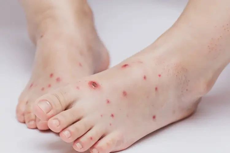 少兒腳上經(jīng)常長濕疹不管它會自己好嗎(圖4)