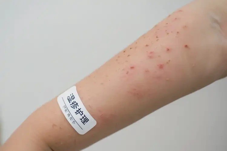 小孩手臂偶爾起濕疹能靠自己自愈嗎(圖4)