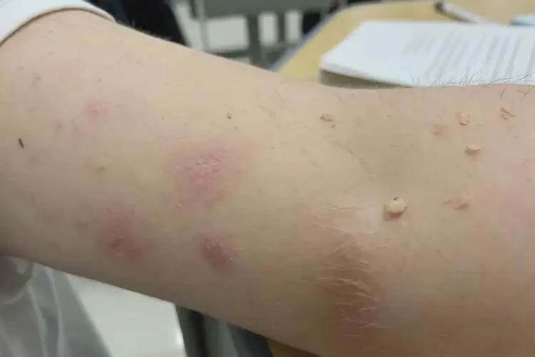 中學生手臂起濕疹能靠自己自愈嗎(圖3)