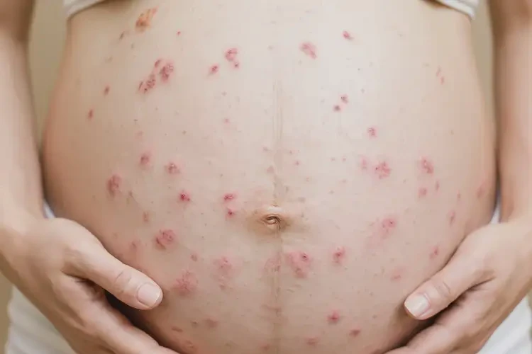 孕婦肚子上有濕疹不管它會(huì)自己痊愈嗎(圖4)