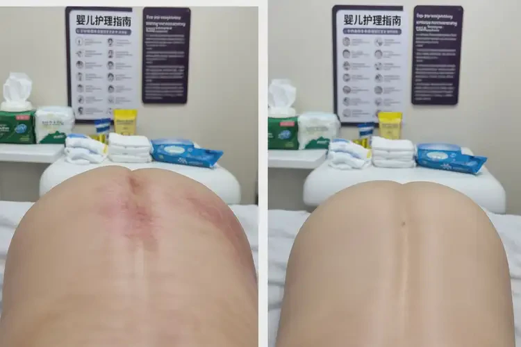 小孩肛周容易长湿疹可以彻底自愈吗(图1)