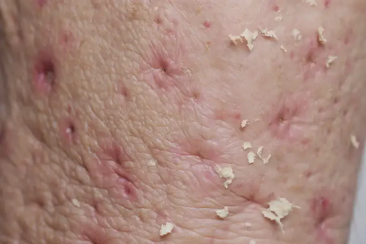 老年人四肢容易長(zhǎng)濕疹不管它會(huì)自己好嗎(圖4)