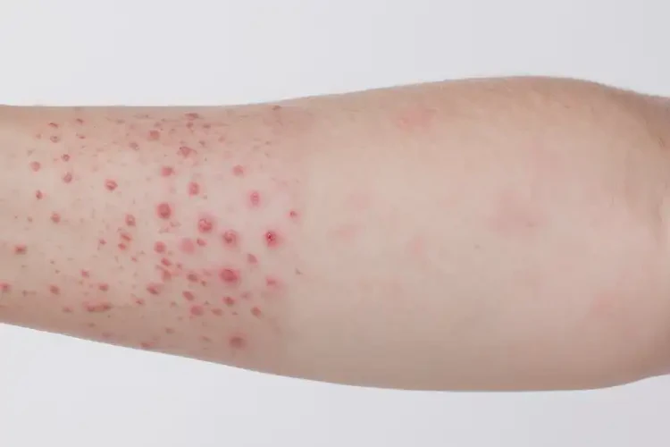 少兒手臂上出現(xiàn)濕疹可不可以徹底自愈(圖3)