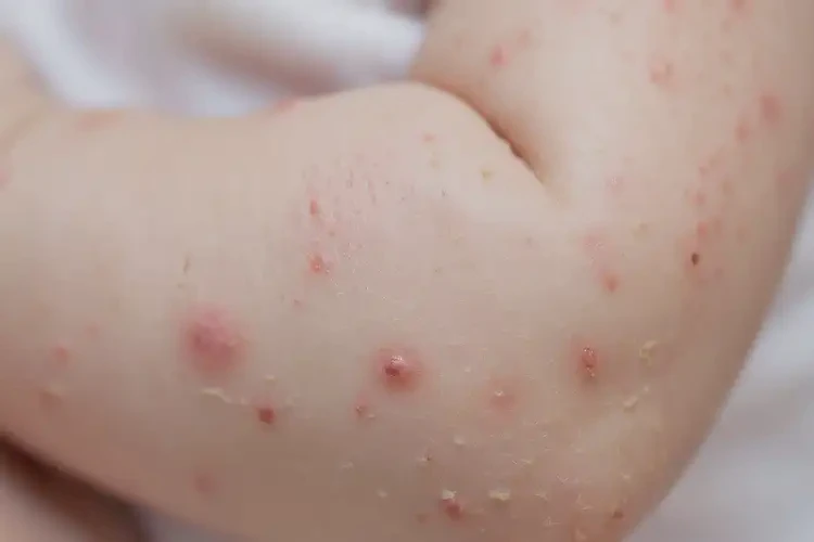 寶寶手臂上起濕疹能靠自己自愈嗎(圖4)