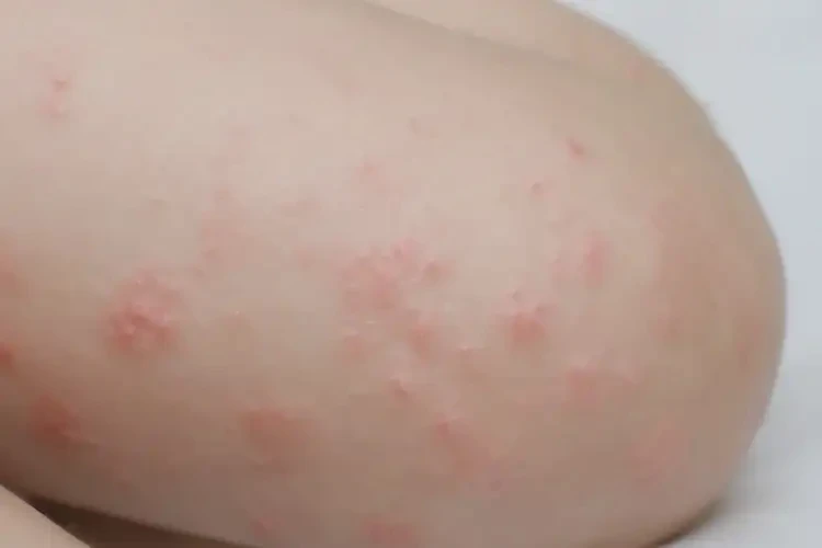 兒童大腿上出現(xiàn)濕疹不管它會自己痊愈嗎(圖4)