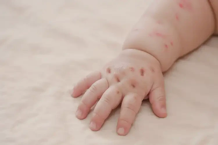 婴儿手上容易起湿疹不管它会自己痊愈吗(图2)