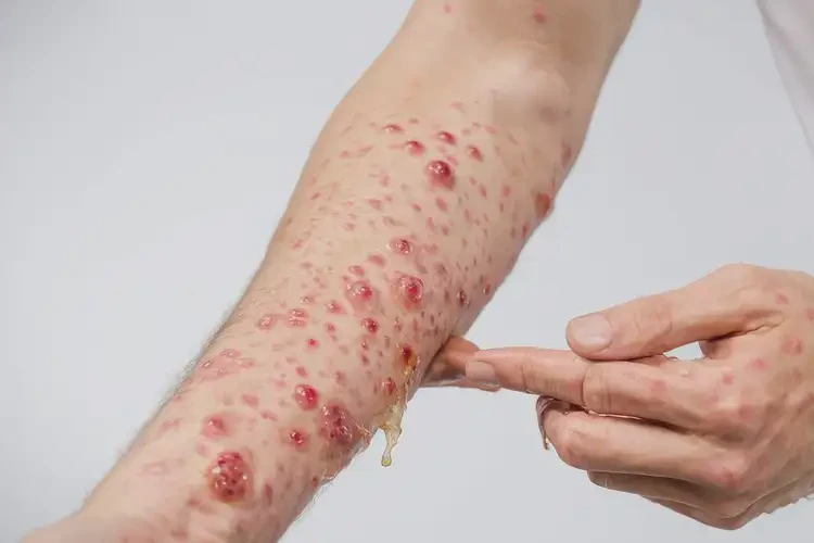 男人肚子偶爾起濕疹不管它會(huì)自己好嗎(圖4)