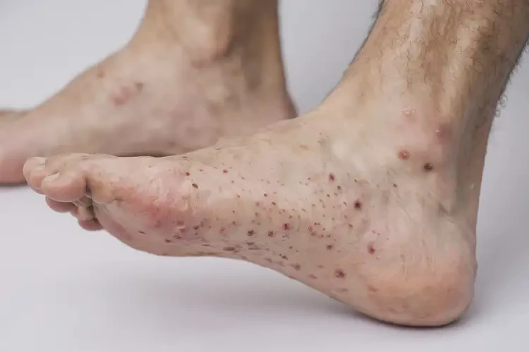 青年人腳上出濕疹可以徹底自愈嗎(圖4)