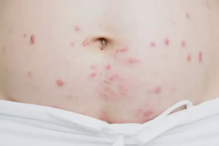 產(chǎn)婦肛周經(jīng)常長濕疹能靠自己自愈嗎(圖4)