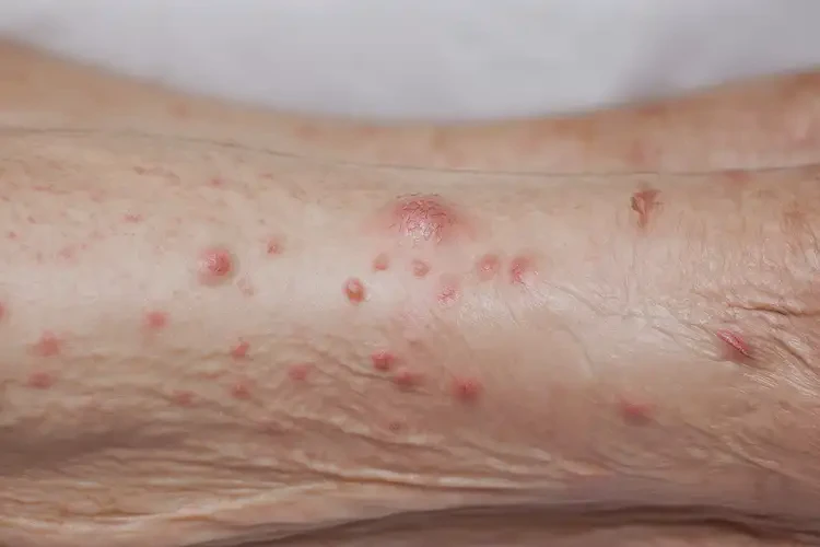 高齡老人小腿偶爾長(zhǎng)濕疹能夠徹底治愈嗎(圖4)