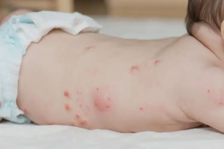 嬰兒屁股上容易長(zhǎng)濕疹能靠自己自愈嗎(圖4)