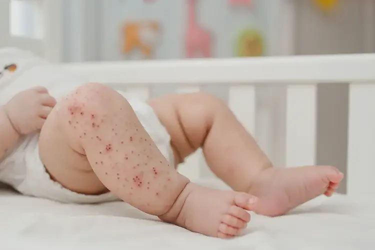 嬰兒屁股上出濕疹能靠自己自愈嗎(圖4)