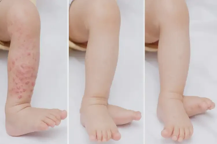 小兒小腿上偶爾長(zhǎng)濕疹不管它會(huì)自己痊愈嗎(圖4)