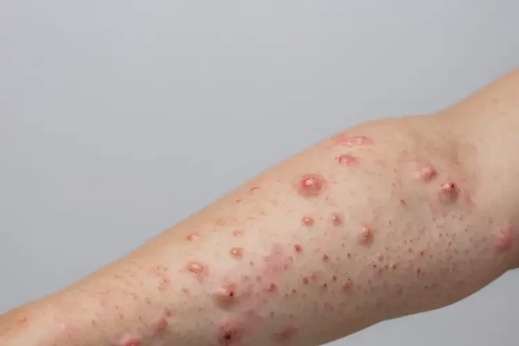 青少年手臂上起濕疹不管它會自己好嗎(圖3)