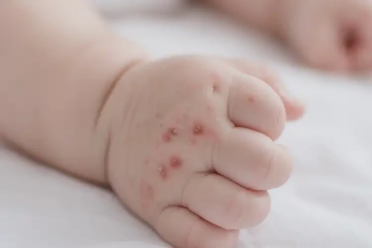 婴儿手上容易起湿疹不管它会自己痊愈吗(图4)