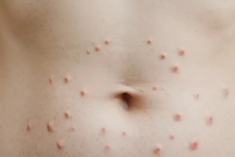 女人肚子容易長濕疹不管它會自己好嗎(圖4)