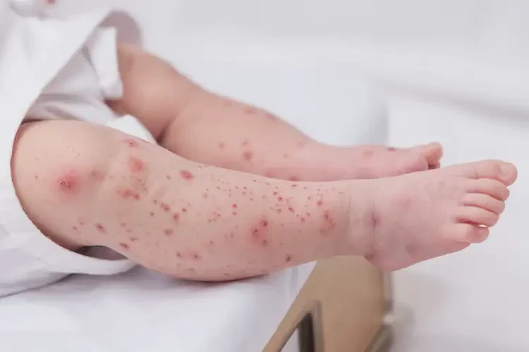 新生兒四肢容易起濕疹能徹底自愈嗎(圖4)