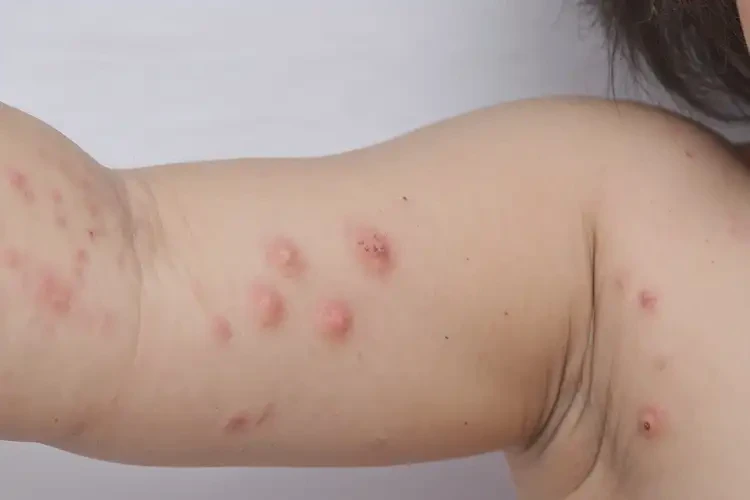 少兒手臂上出現(xiàn)濕疹可不可以徹底自愈(圖4)