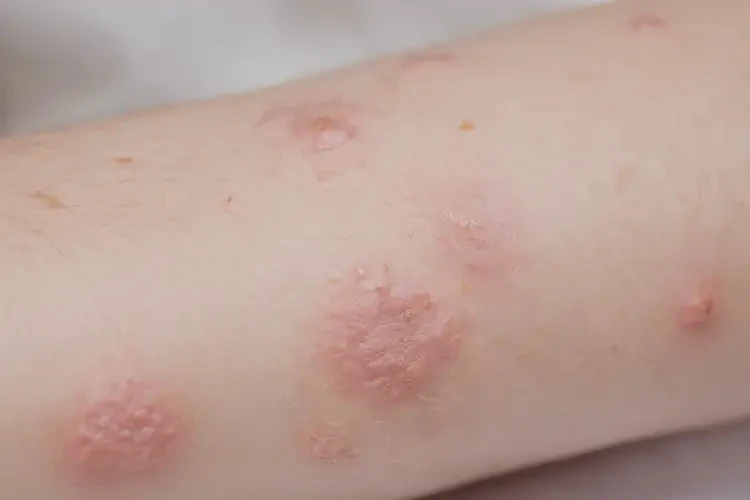 兒童手臂經(jīng)常長濕疹可以徹底自愈嗎(圖4)