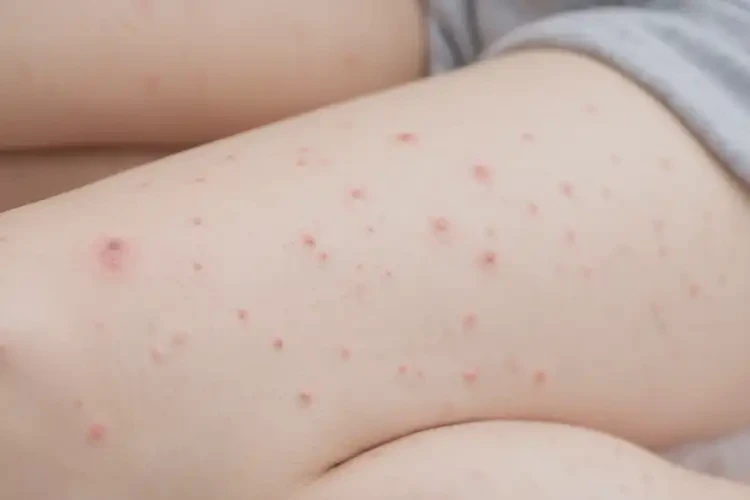 女性大腿偶爾起濕疹不管它會(huì)自己好嗎(圖3)