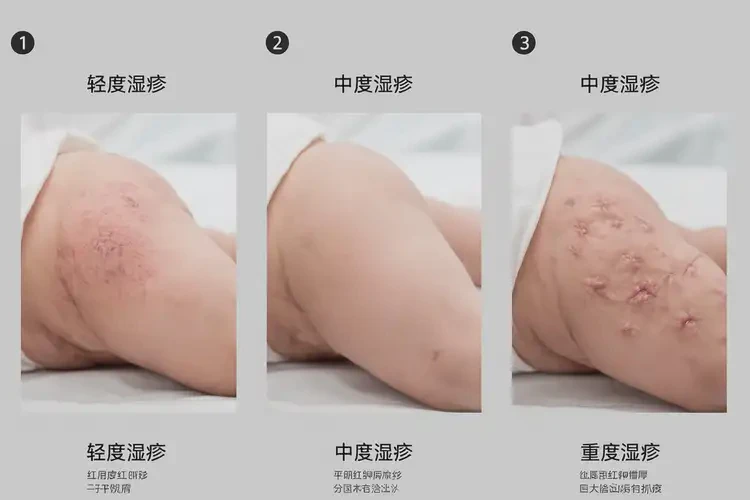 寶寶屁股上偶爾起濕疹不管它會自己痊愈嗎(圖3)