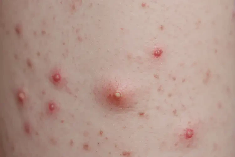 嬰幼兒小腿出濕疹不管它會自己痊愈嗎(圖4)