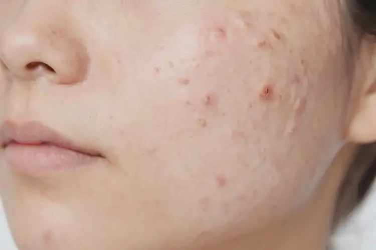 男人面部長(zhǎng)濕疹可以徹底自愈嗎(圖4)