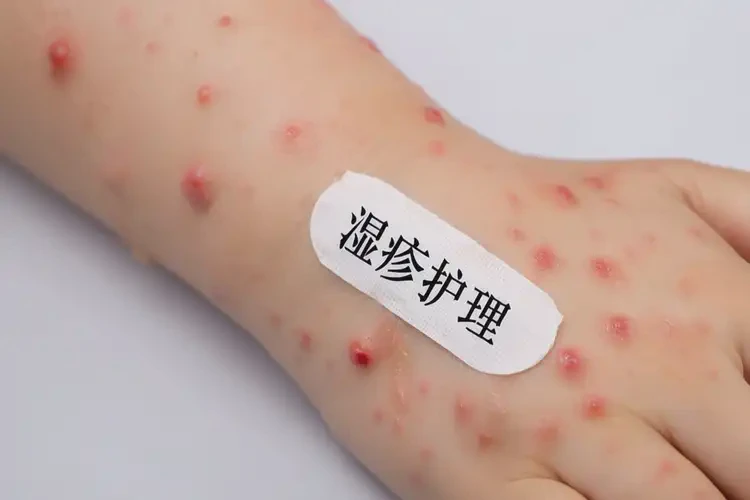 孩子手臂上容易長濕疹可不可以徹底自愈(圖4)