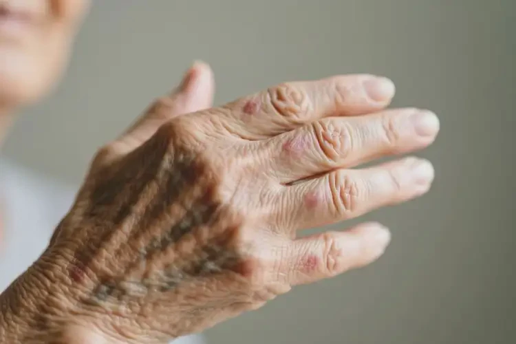 老年人身上偶爾長濕疹可不可以徹底自愈(圖4)