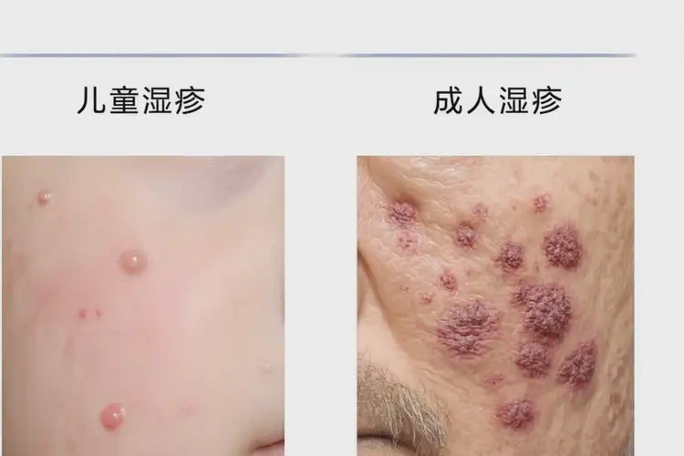 女生手臂上偶爾起濕疹不管它會(huì)自己痊愈嗎(圖2)